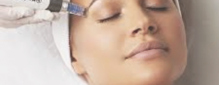 Microneedling plus Uber Pro Peel Fourways
